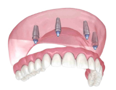 Four implant fixed full arch dental implants in Denison, Texas