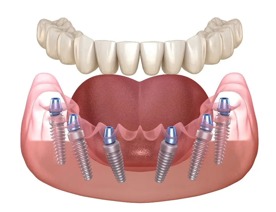 Fixed full arch implant supported dentures in Denison, Texas