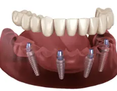 Permanent zirconia full arch dental implants in Denison, Texas